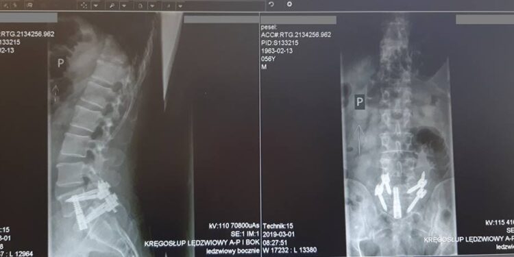 Skuteczniejsza walka ze zwyrodnieniem kręgosłupa