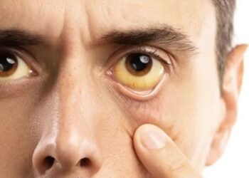 W Pradze spadła dynamika zakażeń wirusowym zapaleniem wątroby typu A